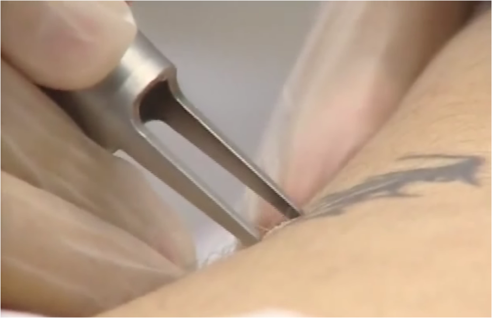 eliminacion tatuajelaser