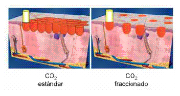 lasermicrofraccionado