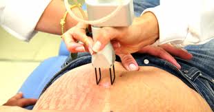 estiaslaser