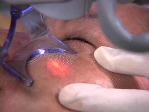 laserfacial